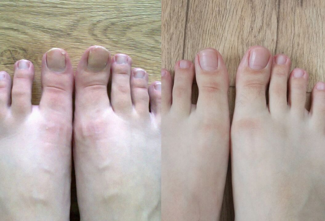 Virun an no der Behandlung, de filgus Promisil Creme