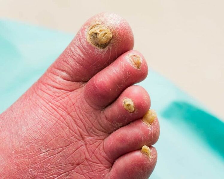 Symptomer vun Onychomycosis