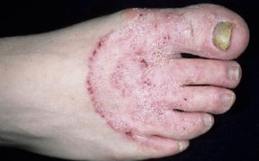 D'Grënn fir d'Erscheinung vum Pilz op de Been