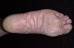 Unzeeche a Symptomer vum Pilz op de Been