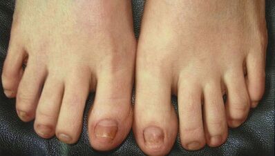 Zännbank vun der Entwécklung vum Neel Pilz