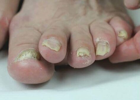 Behandlung vun Nagelpilz mat Medikamenter