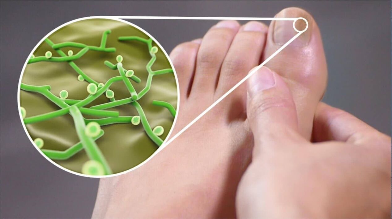 Pathogenen vum Zehennagelpilz