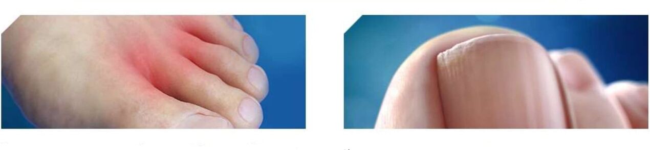 Ufanksstadium vum Fousspilz